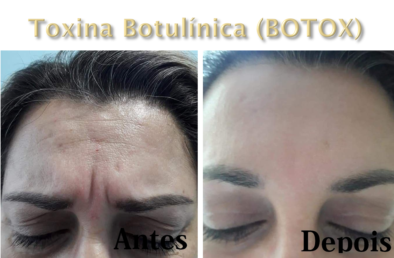 Harmonização Orofacial