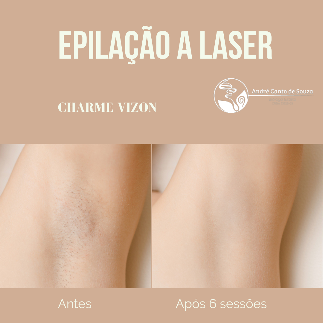 Depilação a laser