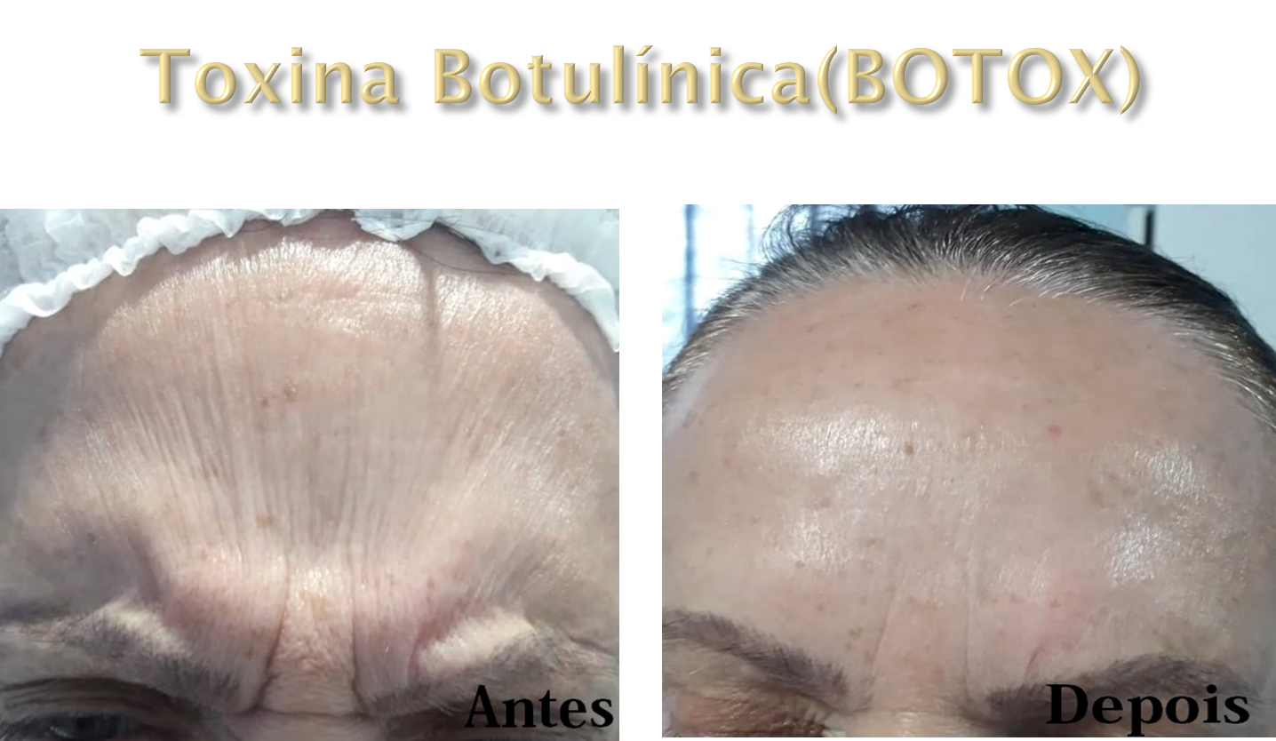 Harmonização Orofacial