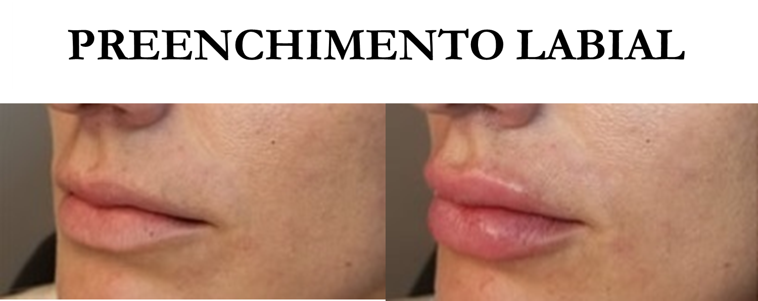 Harmonização Orofacial