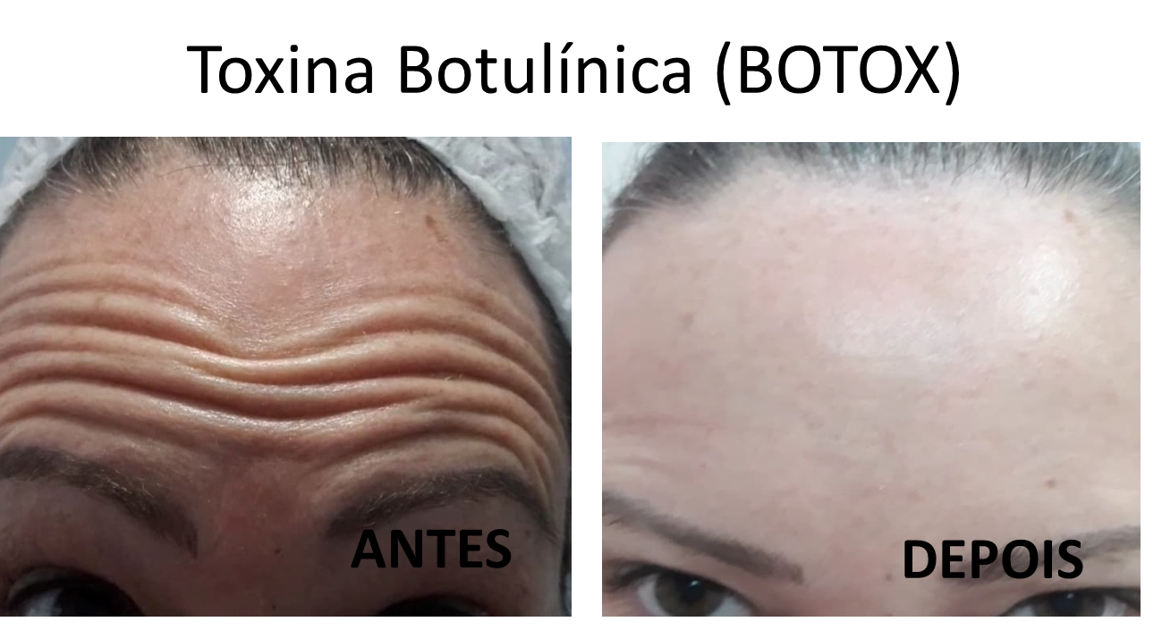 Harmonização Orofacial